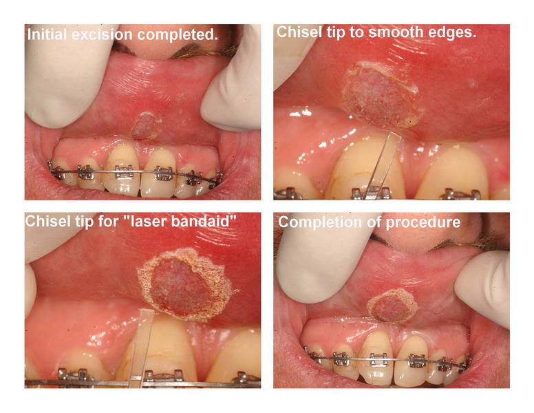 JP frenectomy edited pg 3_resize.jpg